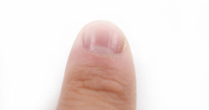 Droge nagelriemen: Een gezonde huidbarrière helpt de nagelriemen beschermen tegen uitdroging en invloeden van buitenaf.