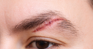 Een litteken in je wenkbrauw ontstaat door huidbeschadiging