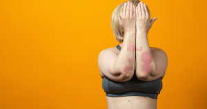 Oogeczeem kan erg vervelend zijn, soms beperkt het zich tot kleine plekjes, terwijl in andere gevallen de hele oogcontour geïrriteerd raakt.