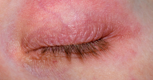 Een voorbeeld van oogeczeem waarbij de roodheid/irritatie heel duidelijk te zien is.