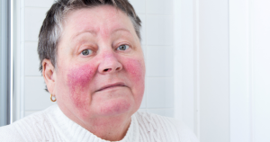 Rosacea kan door stress duidelijk verergeren, wat zichtbaar wordt in roodheid en een gevoelige huid.