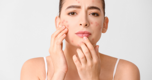 Uitslag in het gezicht door stress kan zich op verschillende manieren uiten, zoals in dit geval door een toename van acne.