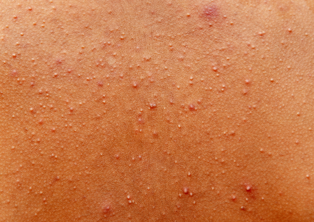 gistpuistjes behandelen