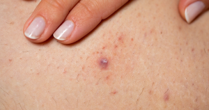 Folliculitis veroorzaakt kleine rode bultjes of puistjes doordat haarzakjes ontstoken raken.