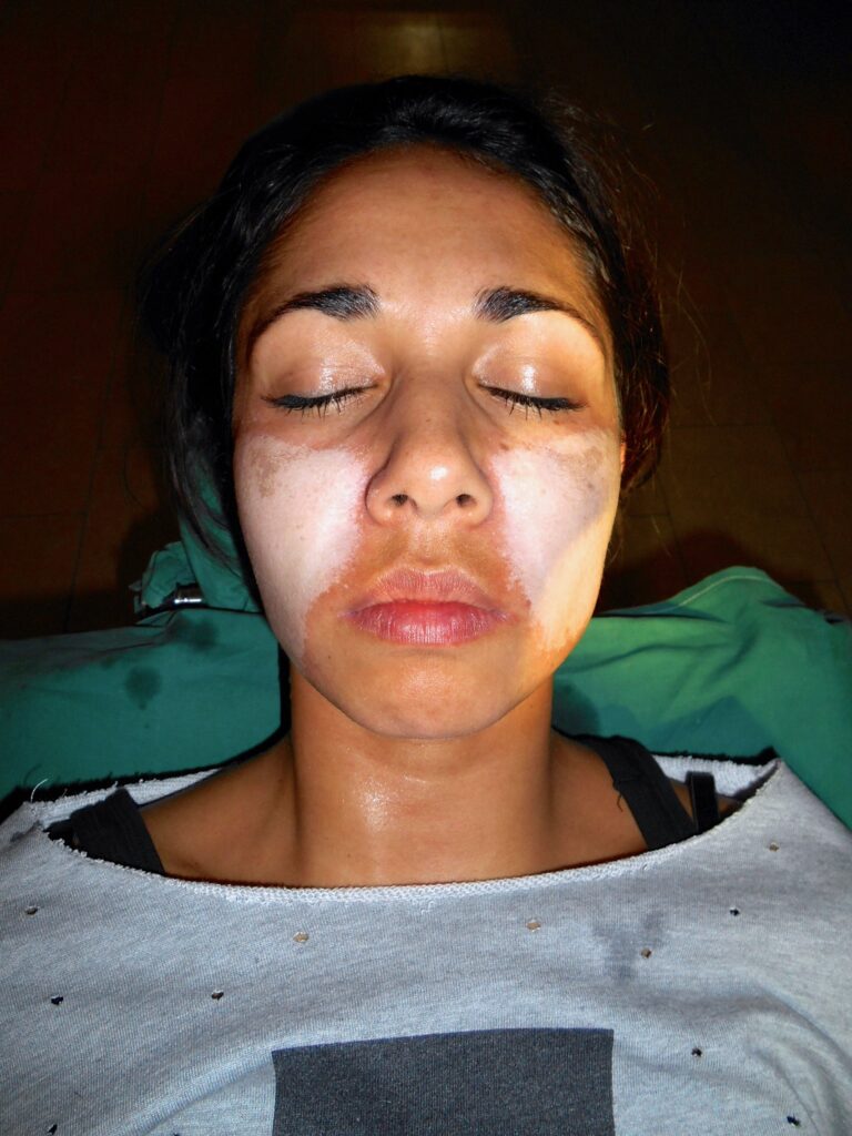 Ervaring TCA peeling, tijdens de behandeling