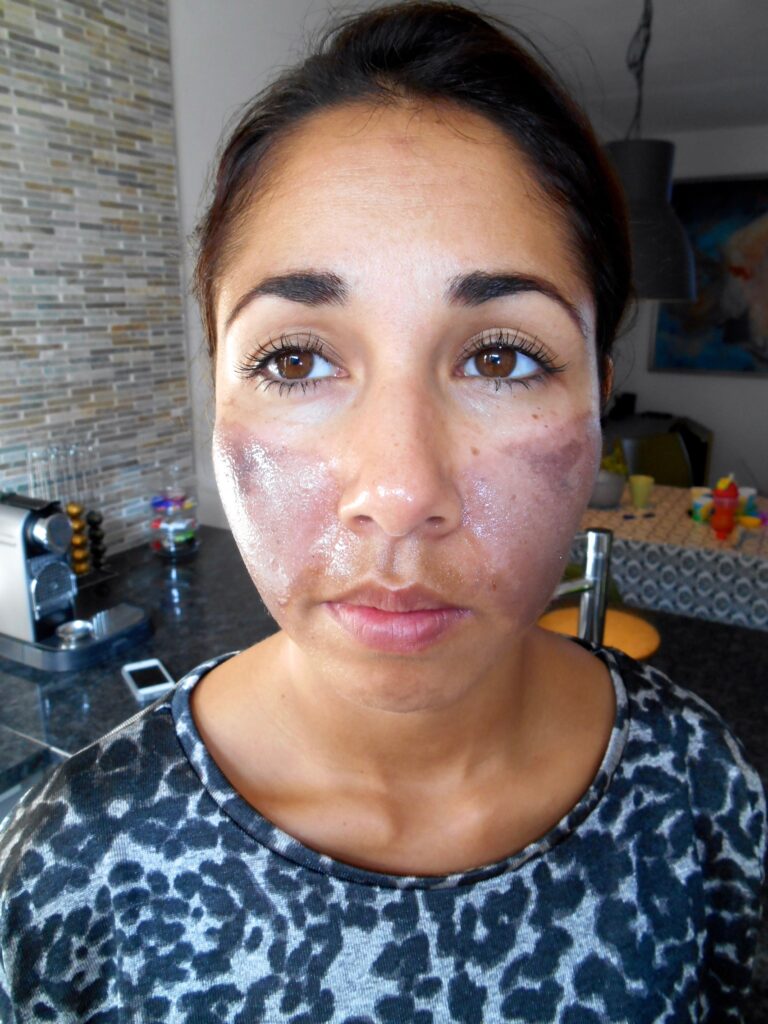 Ervaring TCA peeling, na 3 dagen