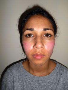 Ervaring TCA peeling, na  dagen