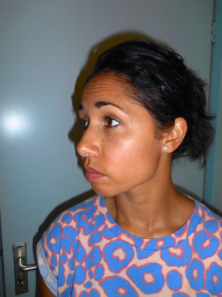 Ervaring TCA peeling, eindresultaat