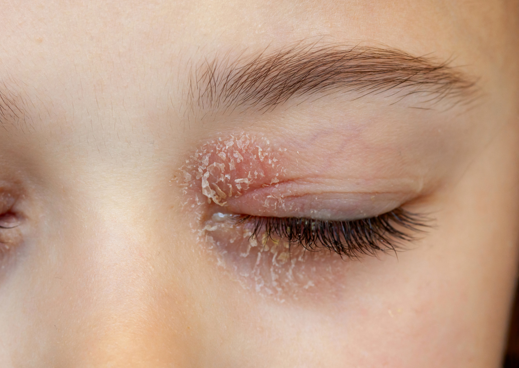 oog eczeem