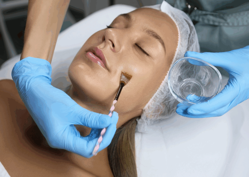 tca peeling ervaring