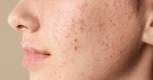 Salicylzuur peeling bij acne