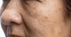 Salicylzuur peeling bij pigmentvlekken