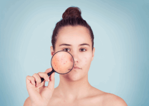 gistpuistjes behandelen: Hoewel gistpuistjes op het eerste gezicht op acne lijken, zijn er duidelijke kenmerkende verschillen.