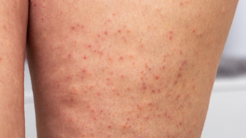 Keratosis pilaris