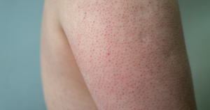 Een voorbeeld van een persoon met keratosis pilaris op de bovenarm.