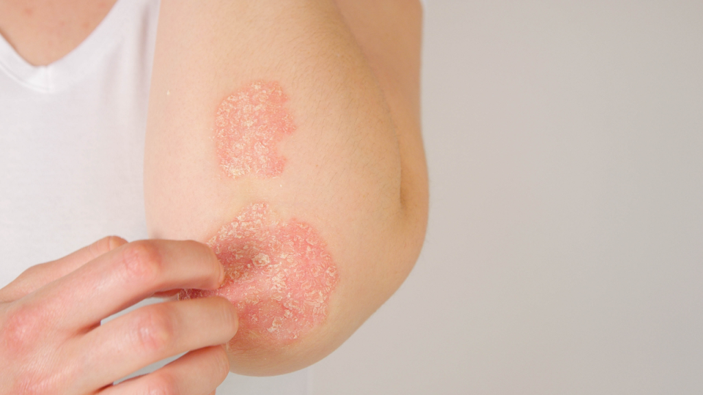 Psoriasis behandelen