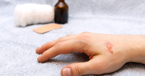 Bij een brandblaar maakt goede eerste behandeling groot verschil, handel daarom snel.