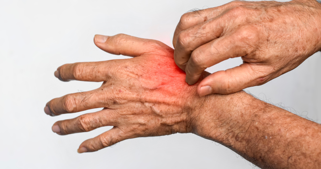 eczeem handen blaasjes: Door een goede huidverzorging kan je jeuk verminderen.