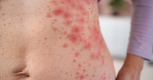 Een voorbeeld van een vrouw met uitslag in haar zij.