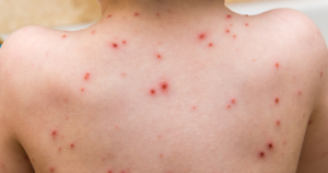 Een voorbeeld van een infectie die uitslag veroorzaakt is waterpokken.