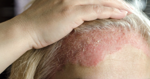 Huidaandoeningen zoals Seborroïsch eczeem, in dit geval in de haargrens, kunnen schilfers in het gezicht veroorzaken.