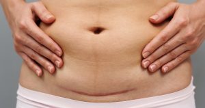 Een voorbeeld van een verdikt litteken: in dit geval een hypertrofisch litteken.