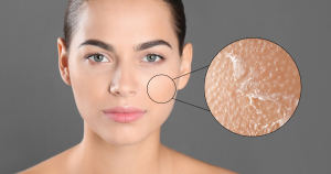 Schilfers in het gezicht komen vaak voor op plekken waar de huid gevoeliger is of waar relatief veel talgklieren zitten.