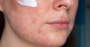 Hormoonzalf gezicht: Een hormoonzalf op het gezicht wordt soms voorgeschreven bij huidklachten zoals rosacea of eczeem.