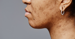 Een voorbeeld van pigmentvlekken veroorzaakt door acne littekens. 