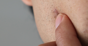 Folliculitis behandeling: Scheer altijd met een scherp mesje zo voorkom je ingegroeide haren.
