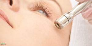 Dermabrasie: Bij microdermabrasie wordt de bovenste huidlaag oppervlakkig behandeld met een speciaal handstuk, bijvoorbeeld met een diamantkop.