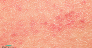 Rode vlekjes op de huid kunnen verschillende oorzaken hebben, zoals irritatie, eczeem of een allergische reactie. Ook jeuk en schilfers kunnen voorkomen.